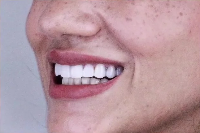 Antes: lentes antigas com dentes quadrados e borda opaca