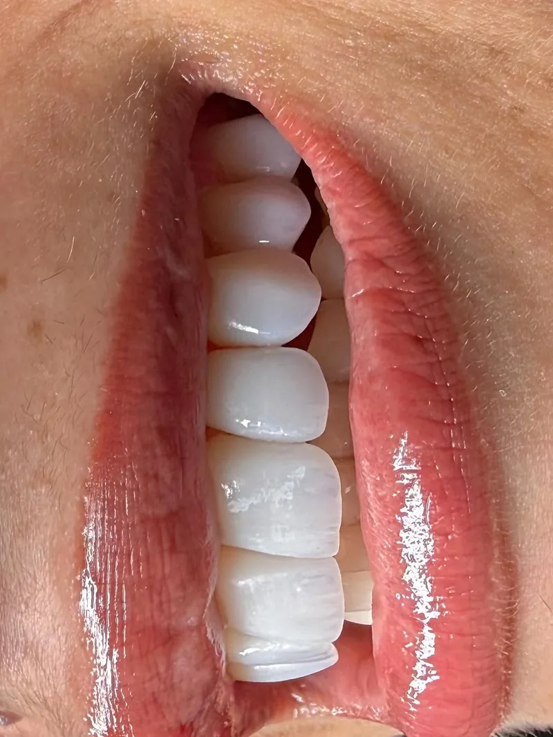 Detalhe de lentes de contato dental com bordas translúcidas