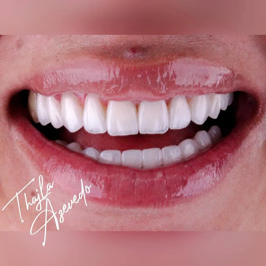 Sorriso com lentes de contato dental na cor BL2 com caracterização